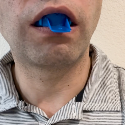 STEP 4: TIME SENSITIVE Put Tray into mouth, and press upper teeth into putty up to at least the gum line STEP 4: TIME SENSITIVE Put Tray into mouth, and press upper teeth into putty up to at least the gum line
